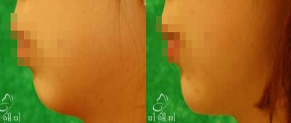 [시술전후사진]무턱필러시술전후사진